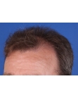 Before Hair Transplant&nbsp;Front